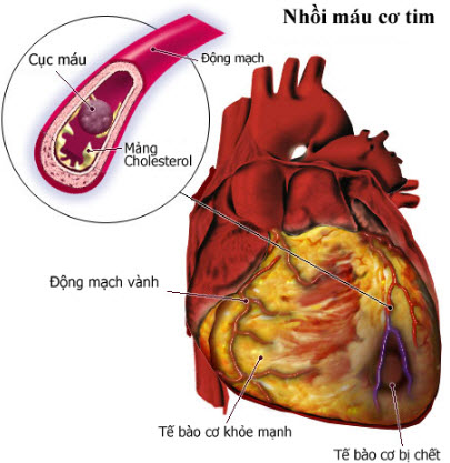 benh-tim(1).jpg