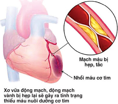 benh-tim(2).jpg