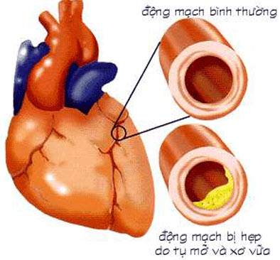 benh-tim(4).jpg