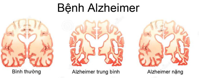 benh-alzheimer(7).jpg