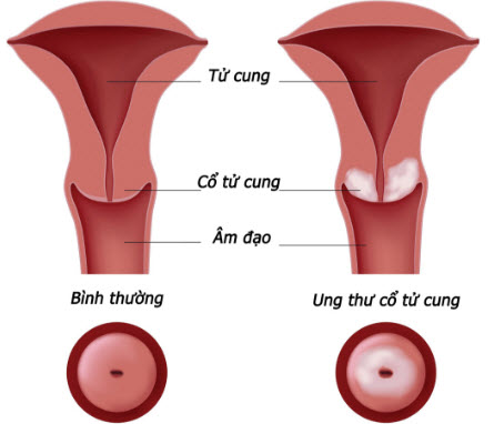 ung-thu-co-tu-cung(1).jpg