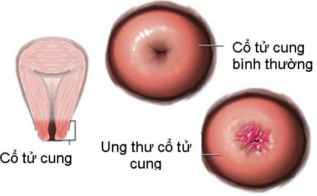 ung-thu-co-tu-cung.jpg